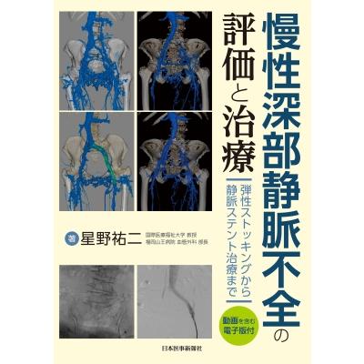 慢性深部静脈不全の評価と治療 弾性ストッキングから静脈ステント治療まで   星野祐二  〔本〕