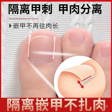 🔥臺灣出貨🔥捲甲矯正器 腳趾甲貼片 甲溝炎 嵌甲 正甲貼墊片 凍甲矯正器 指甲矯正甲溝炎矯正神器指甲往肉裏長專用嵌甲正甲