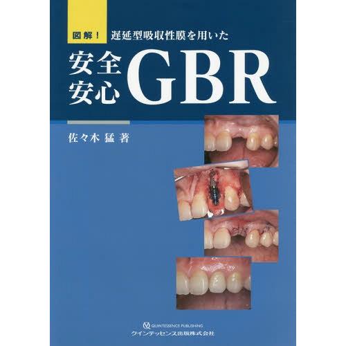 図解 遅延型吸収性膜を用いた安全安心GBR