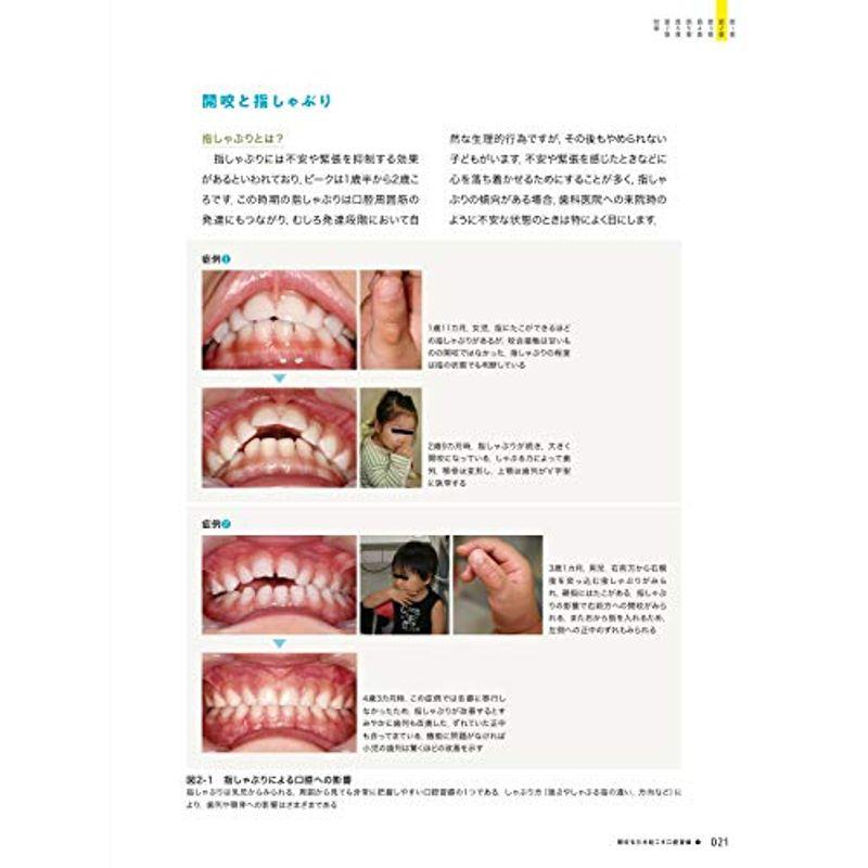 口腔習癖 見逃してはいけない小児期のサイン