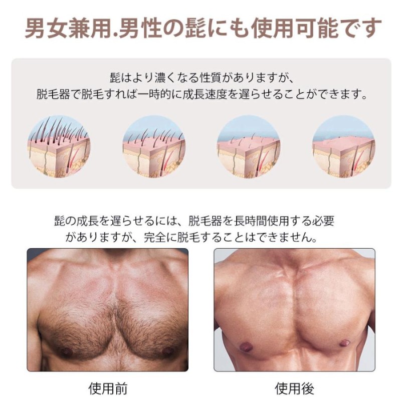 クーポンで8999円】痛くない冷感脱毛器VIO対応 男女兼用 1年保証 家庭