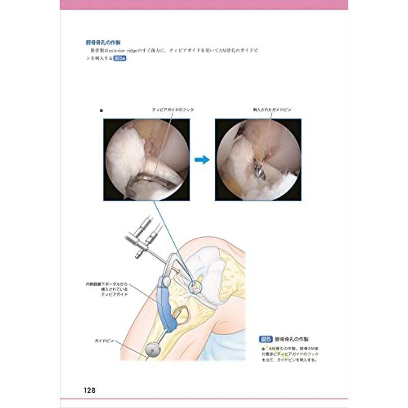 関節鏡手術の基本−ルーチン操作とデバイスの扱い方 (OS NEXUS（電子版 